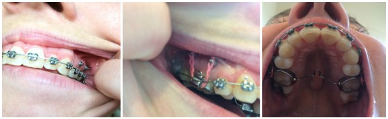 braces-tads-tpa